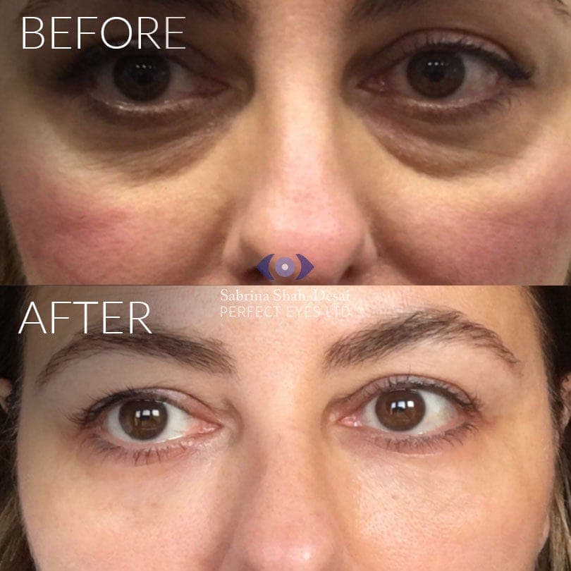 Tear Trough Fillers before and after, a patient of Dr Sabrina Shah-Desai