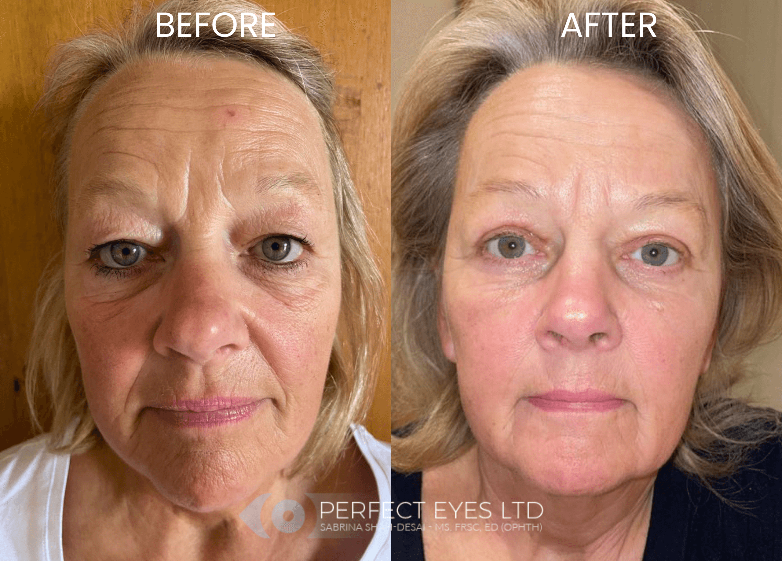 UltraClear Laser before and after - case 2