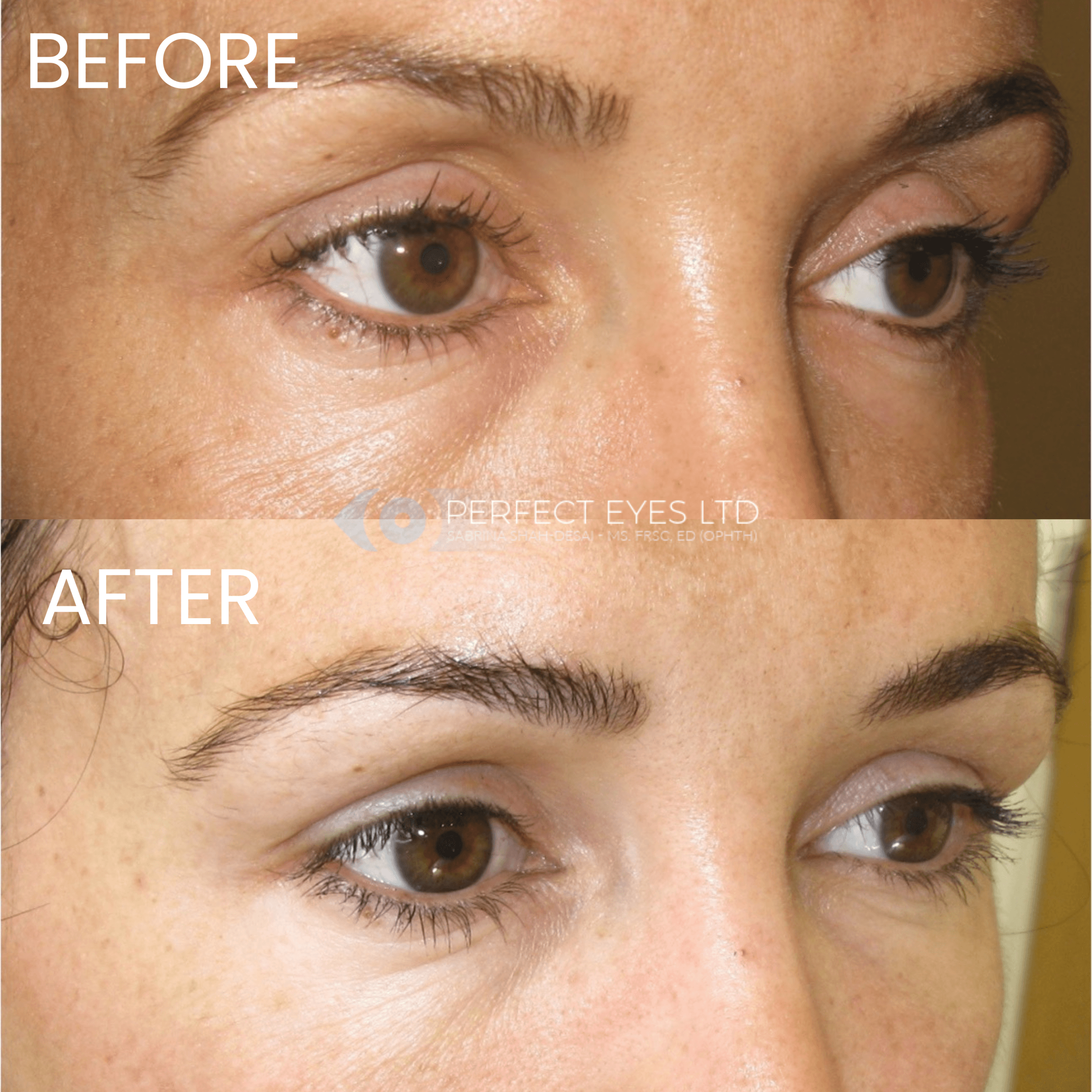 Superior Sulcus Filler before and after - case 1