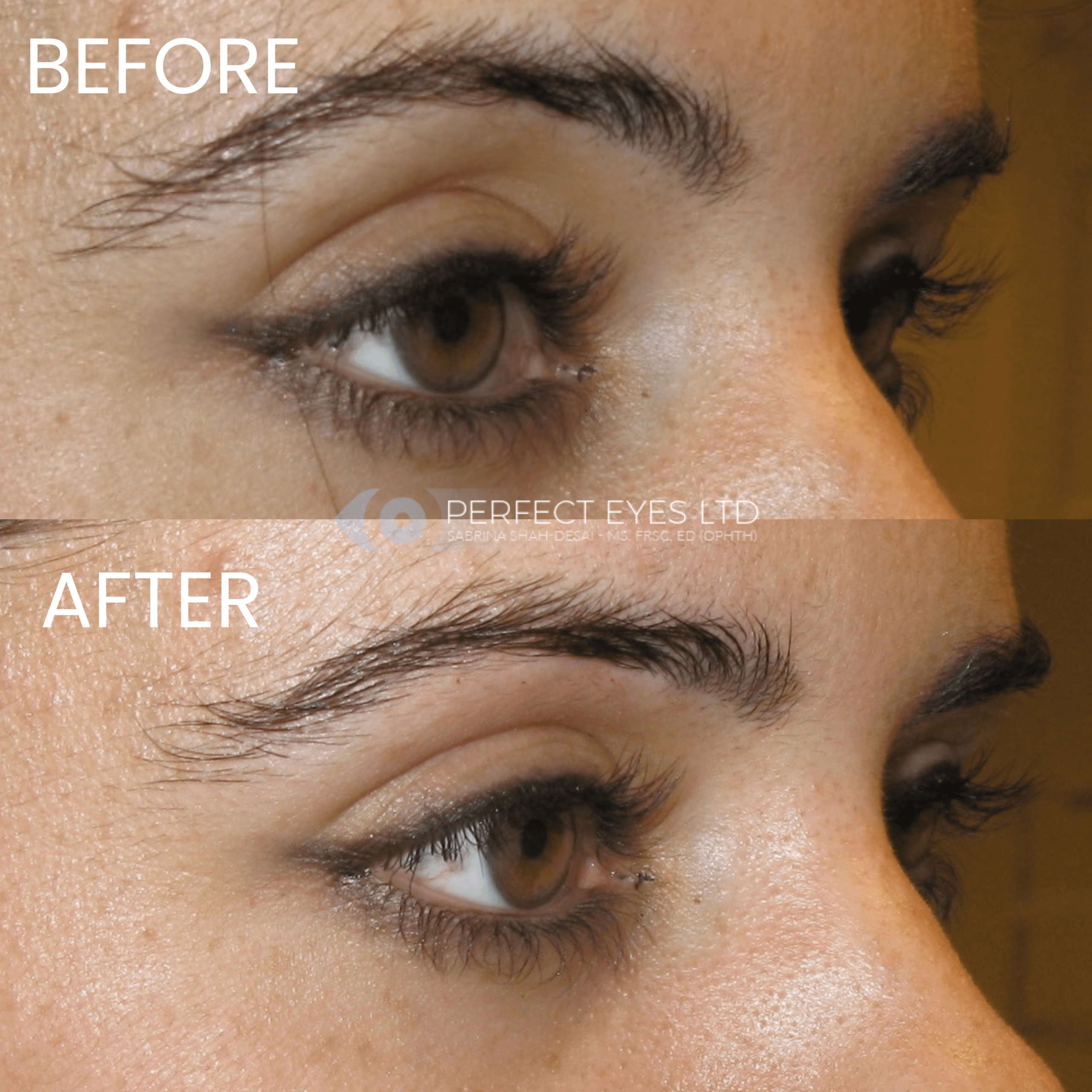 Superior Sulcus Filler before and after - case 2
