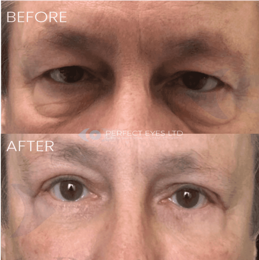 Festoon and Malar Bags before and after, a patient of Dr Sabrina Shah-Desai