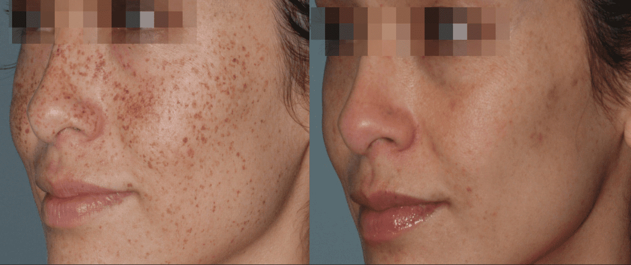Morpheus8 before and after - case 5