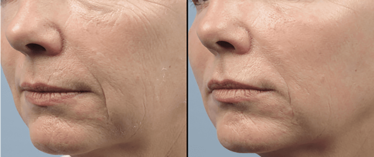 Morpheus8 before and after - case 11