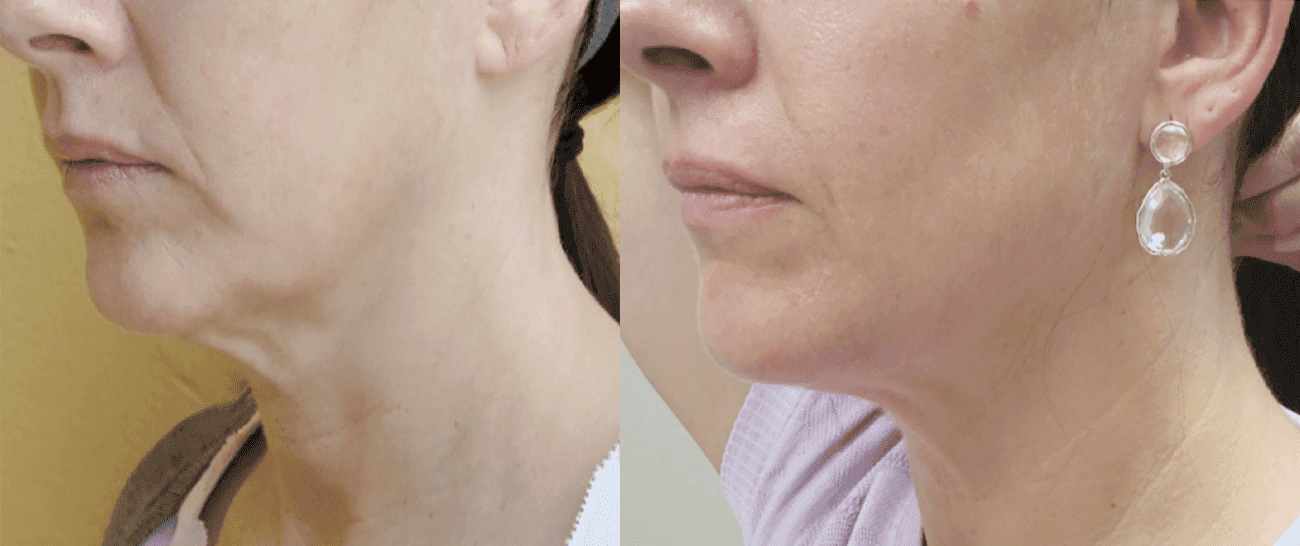 Morpheus8 before and after - case 10