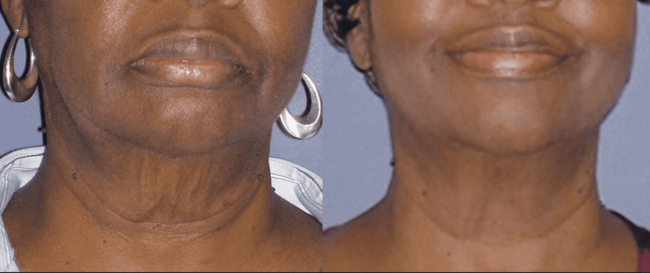 Morpheus8 before and after - case 9
