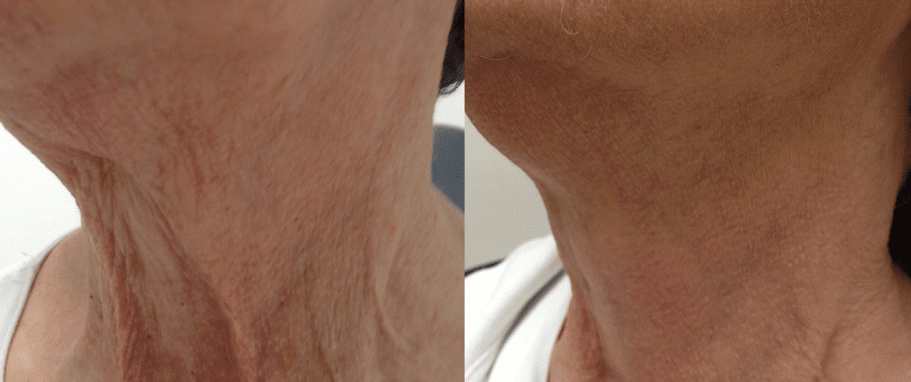 Morpheus8 before and after - case 8