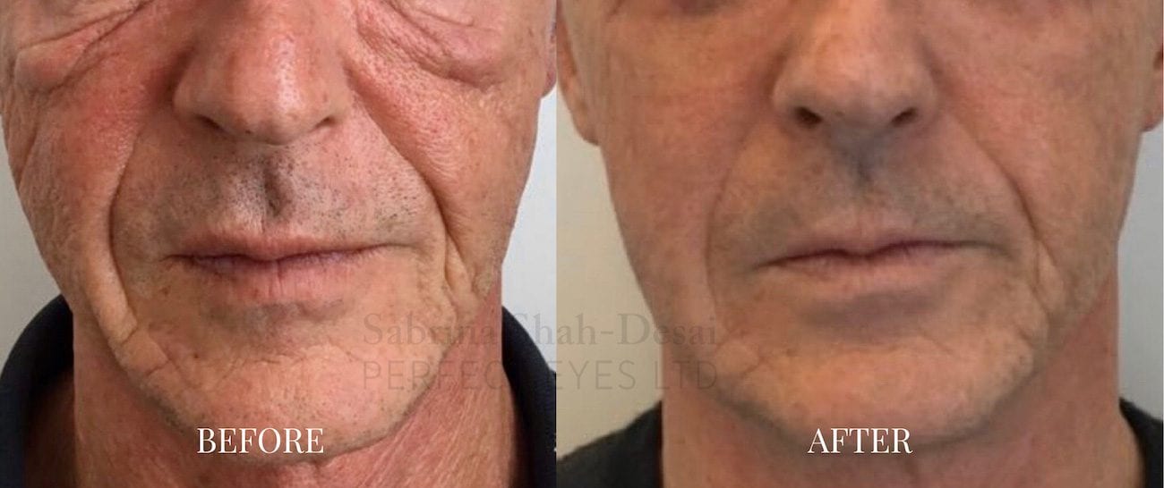 Morpheus8 before and after - case 2