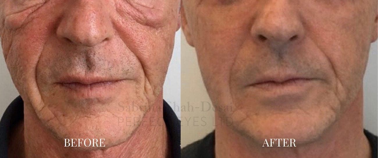 Morpheus8 before and after - case 2