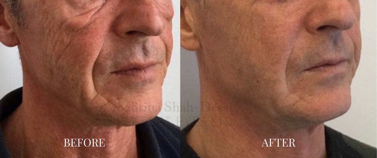 Morpheus8 before and after, a patient of Dr Sabrina Shah-Desai