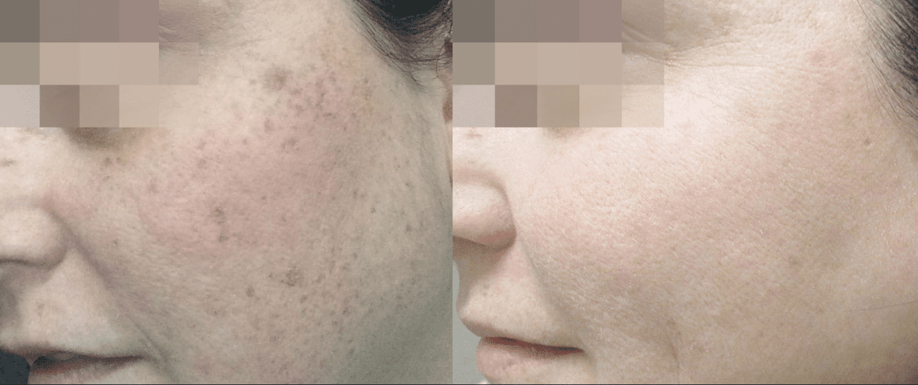 Morpheus8 before and after - case 6