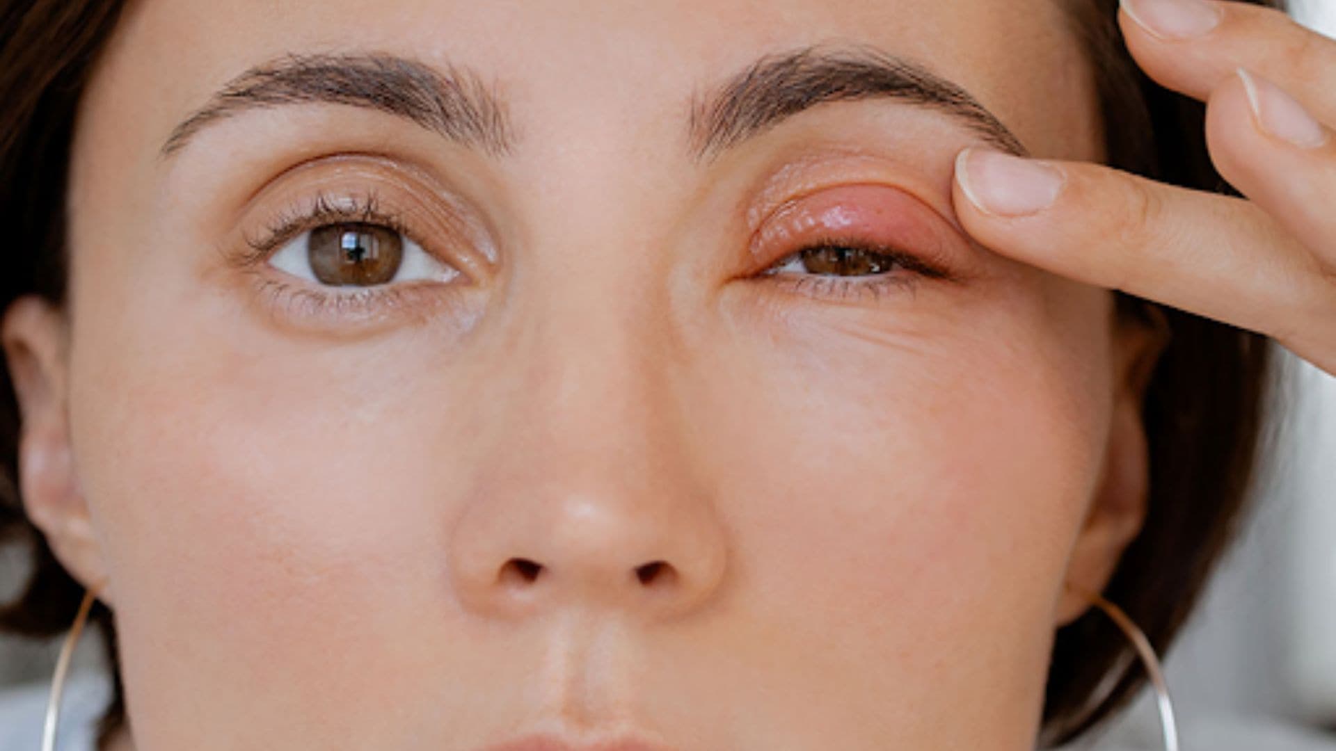 How Long Does A Chalazion Last