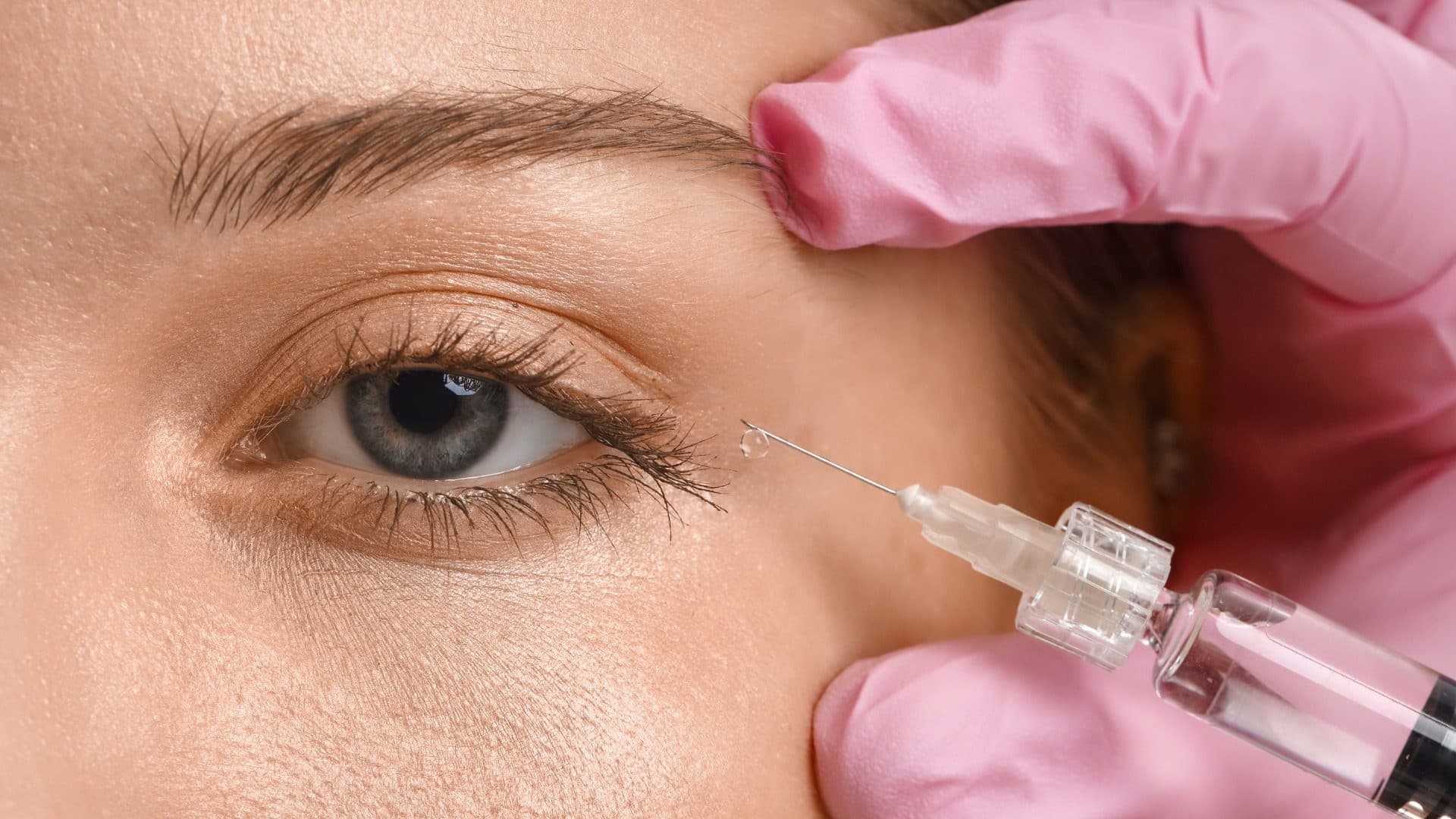 Tear Trough Filler Gone Wrong