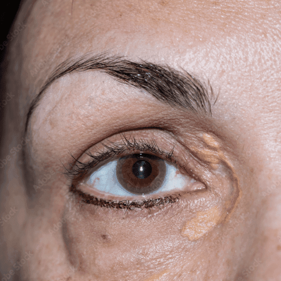 Xanthelasma