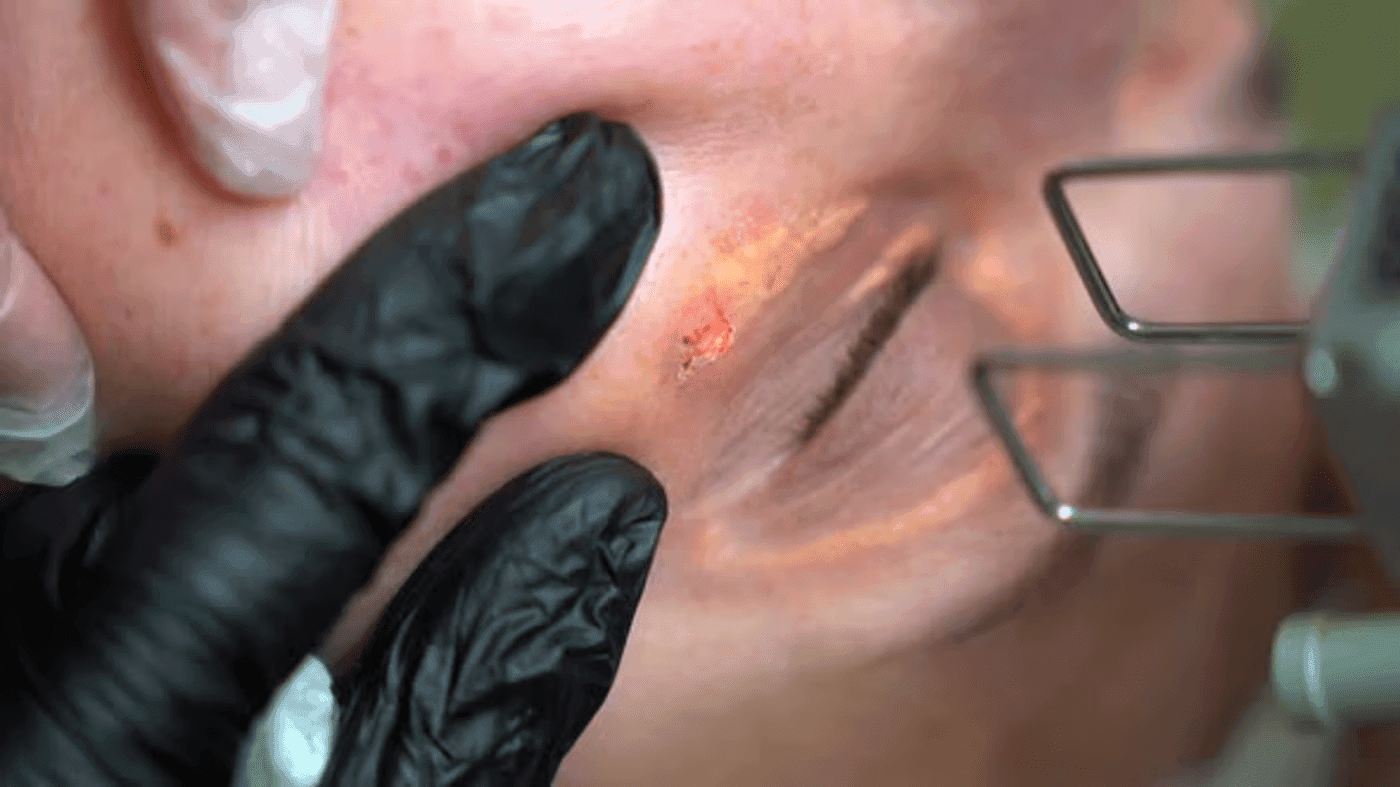 What is Xanthelasma?
