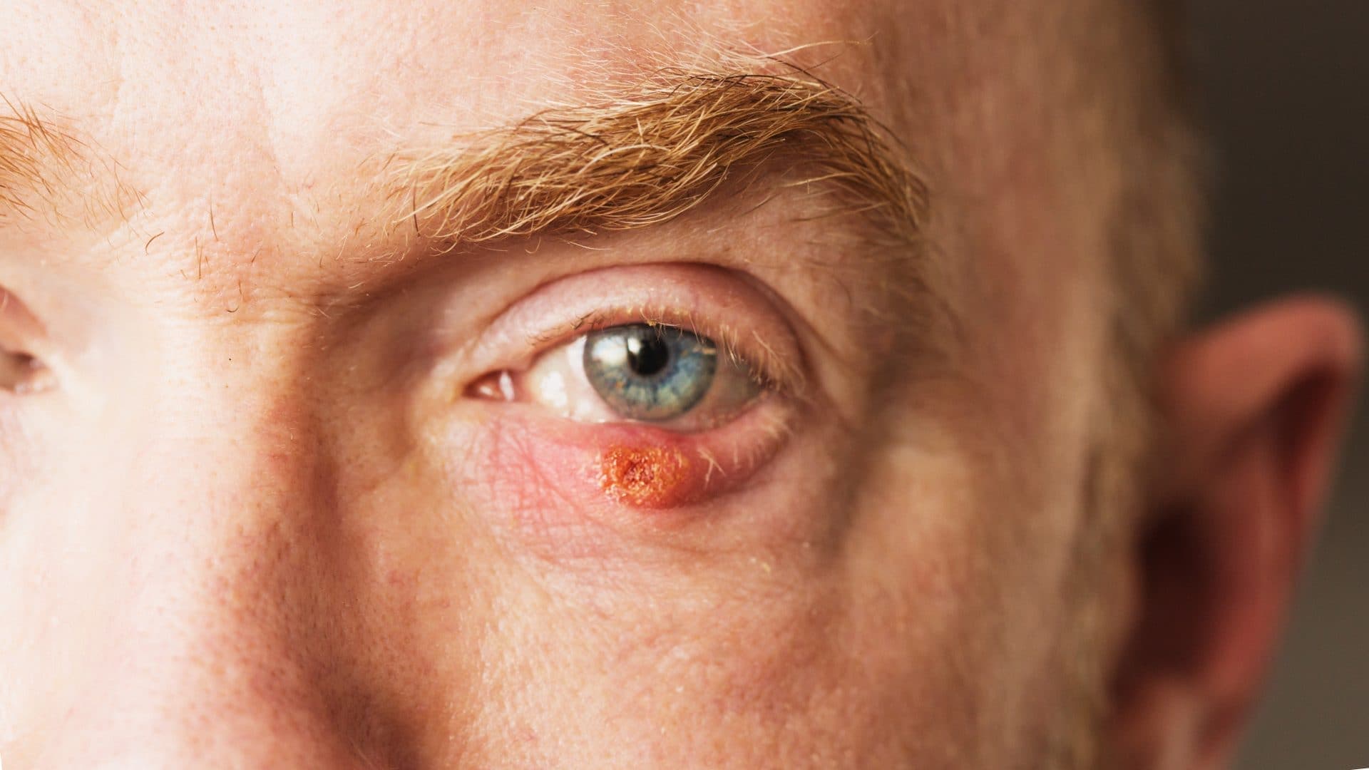 How to Get Rid of Stye on Eyelid Fast