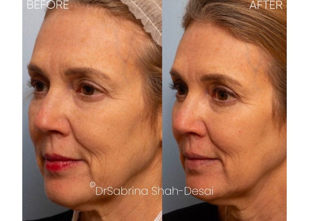 UltraClear Laser before and after - case 5