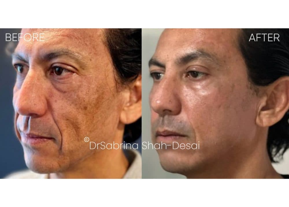 UltraClear Laser before and after - case 6