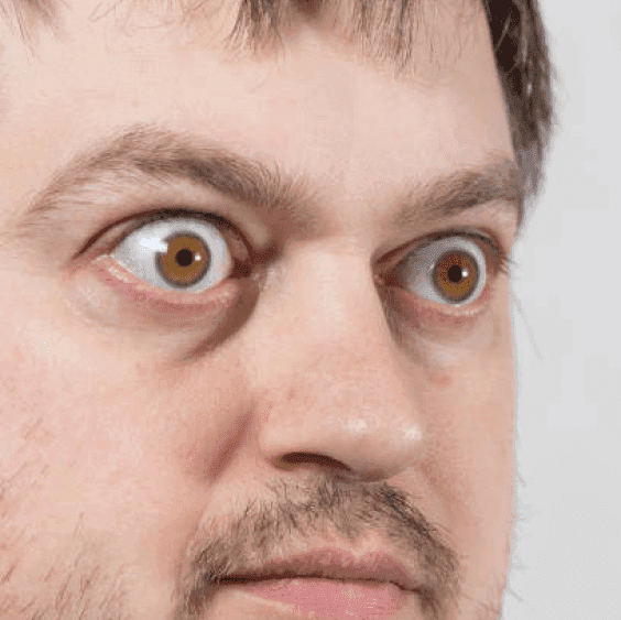 Thyroid Eye Disease (Graves' Disease)