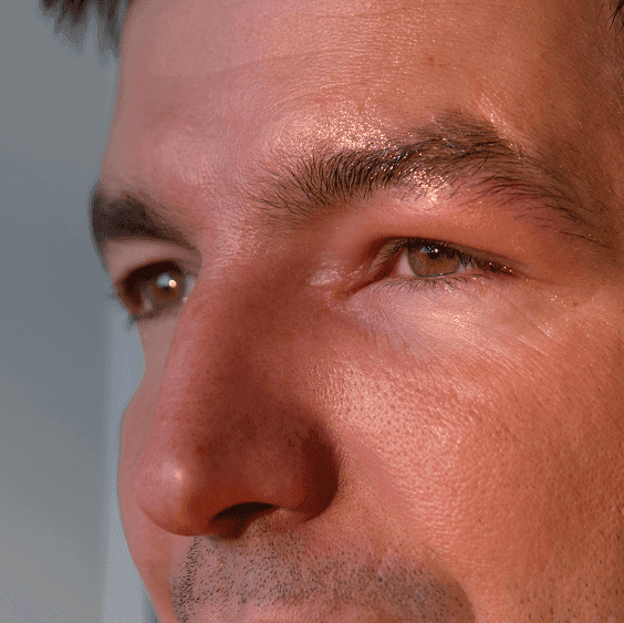 Swollen Eyelids