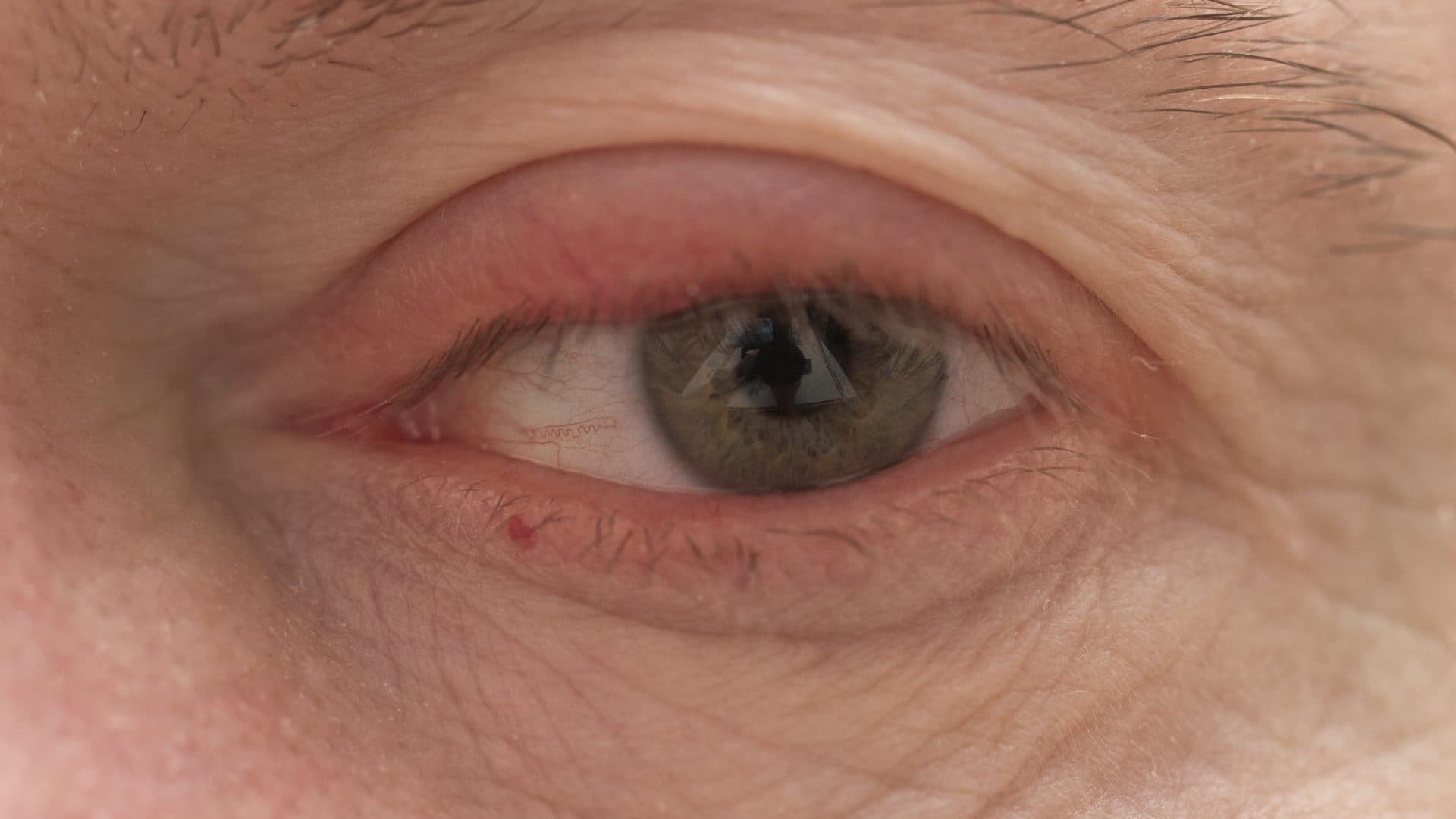 Why My Eyelid is Swollen?