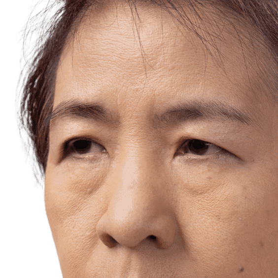 Droopy Eyelids or Ptosis