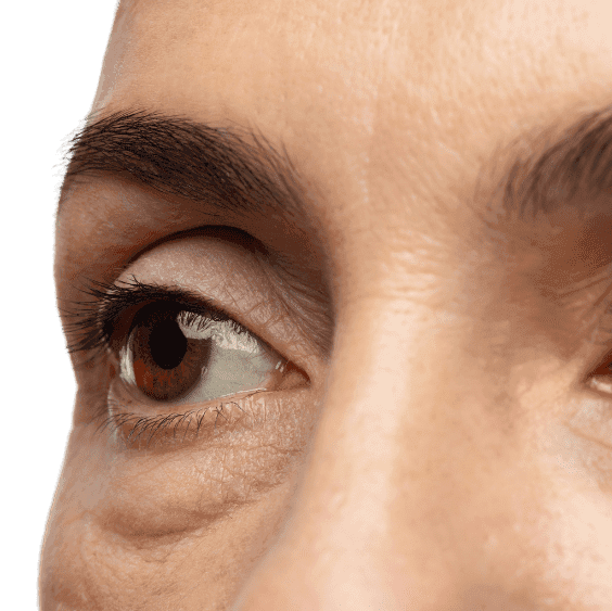 Eye Bags
