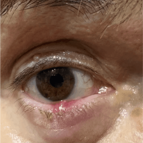 Eyelid Cancer