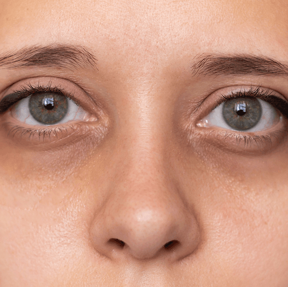 Dark Circles Under Eyes