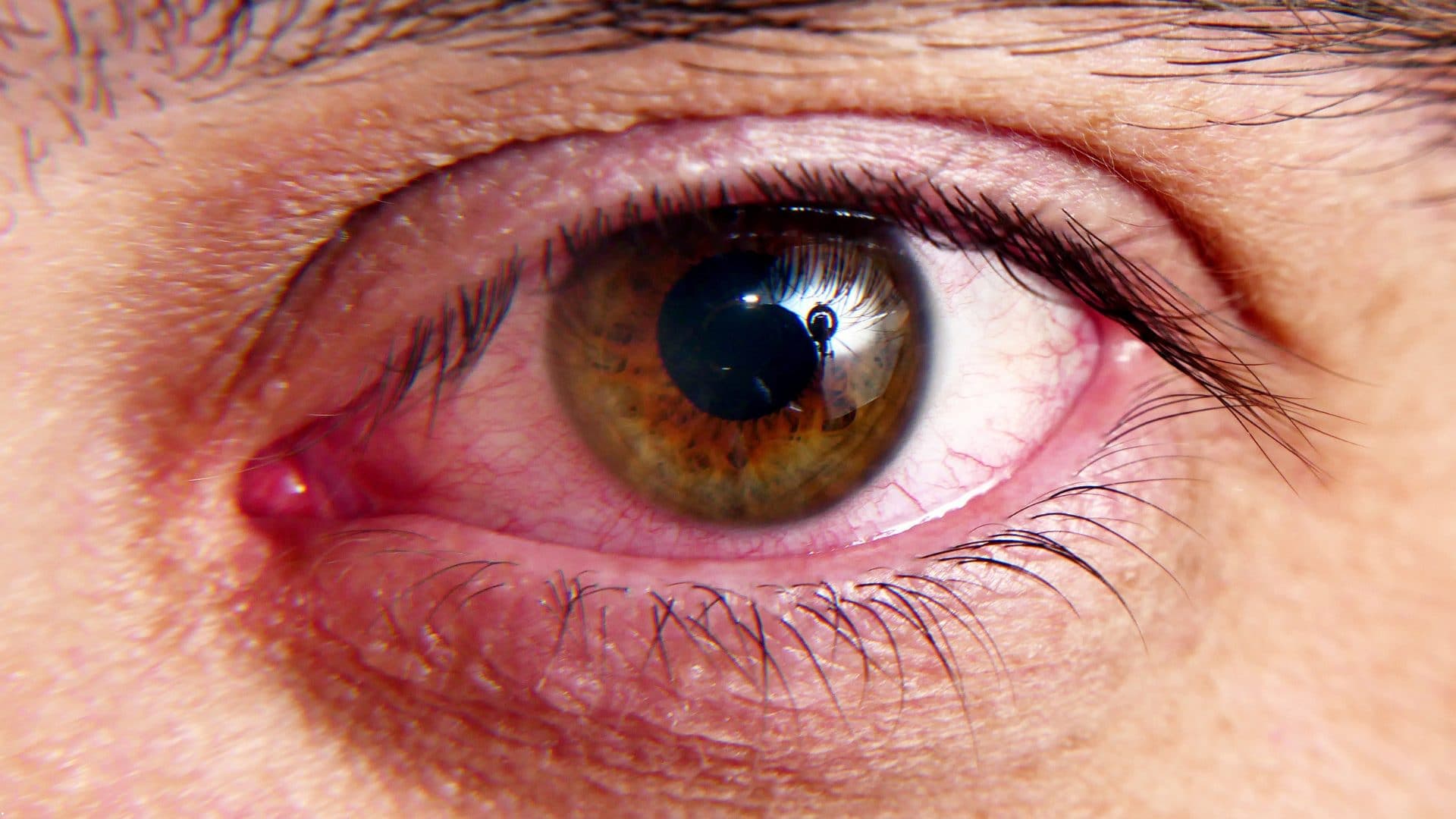 How to Cure Dry Eyes Permanently?