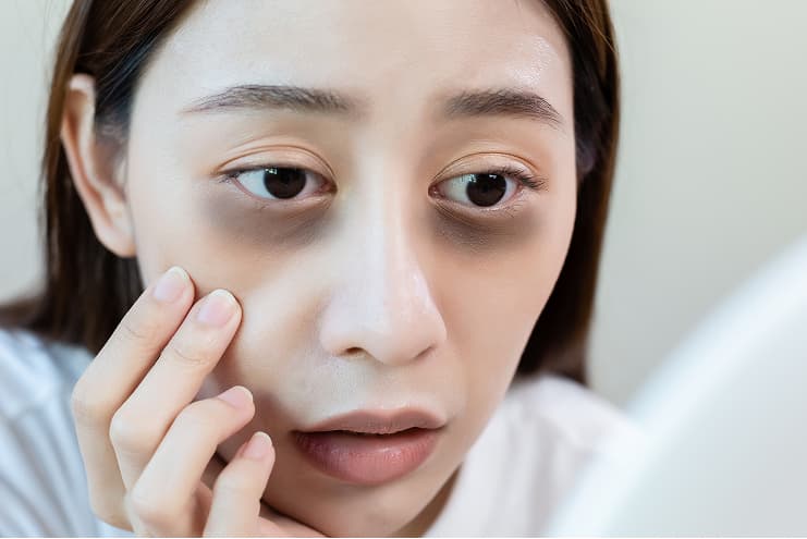 What are Dark Circles Under Your Eyes?