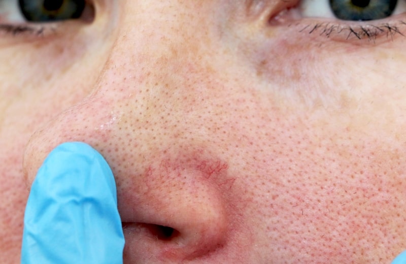 How to Shrink Pores Permanently: A Complete Guide