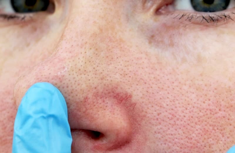 How to Shrink Pores Permanently: A Complete Guide