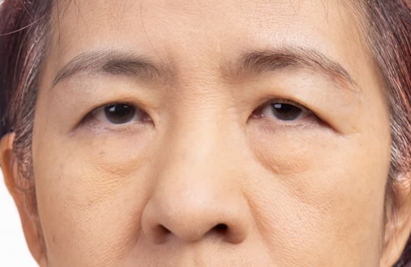 Sudden Droopy Eyelids: Causes, Symptoms, and Diagnosis