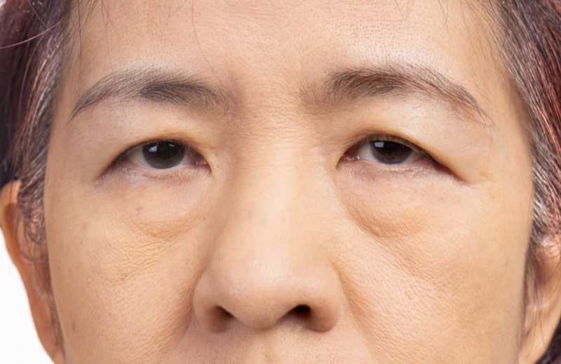 Sudden Droopy Eyelids: Causes, Symptoms, and Diagnosis