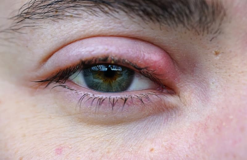 Why Do I Suddenly Keep Getting Styes?