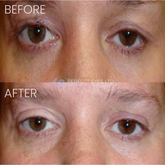 Revision Blepharoplasty before and after, a patient of Dr Sabrina Shah-Desai