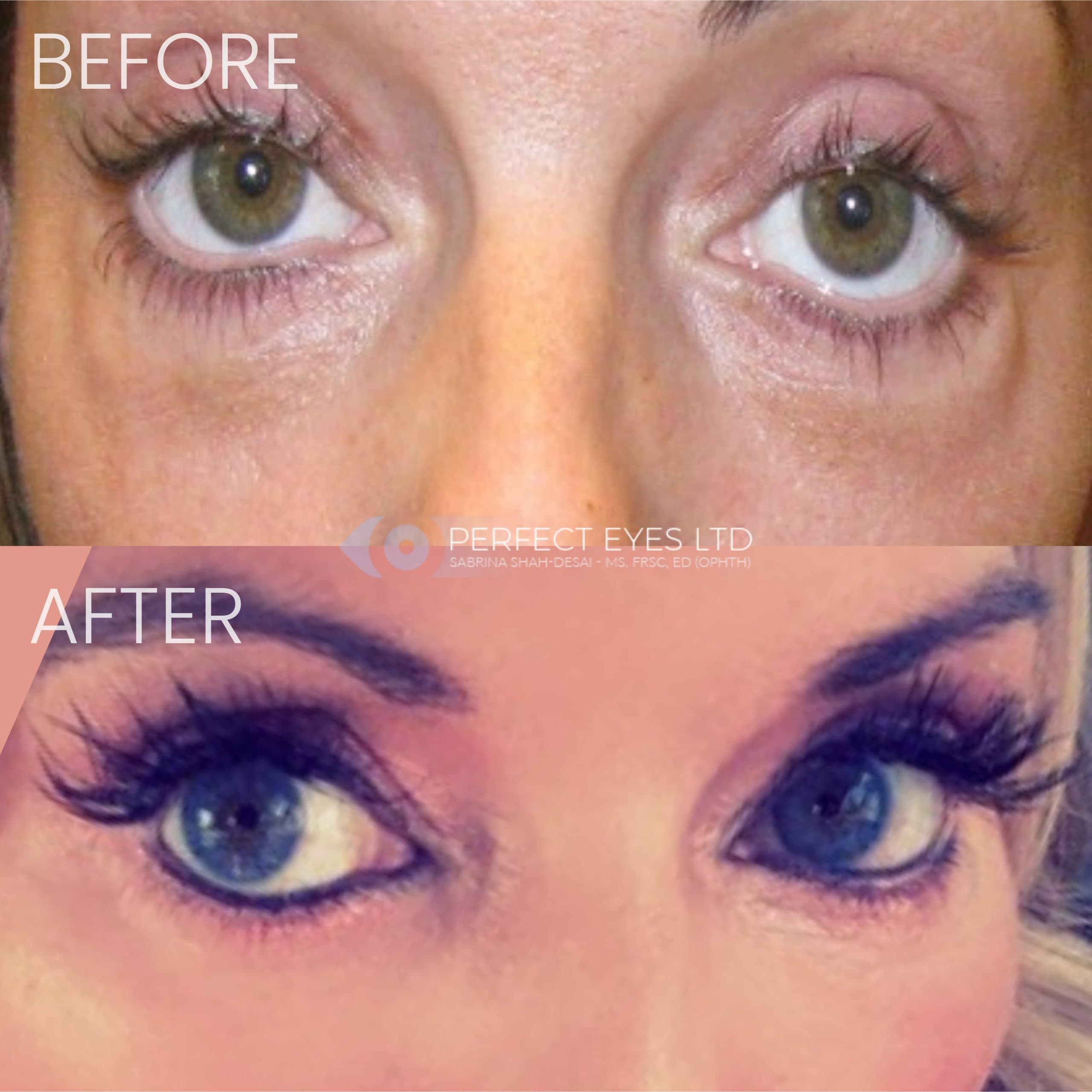 Revision Blepharoplasty before and after - case 3