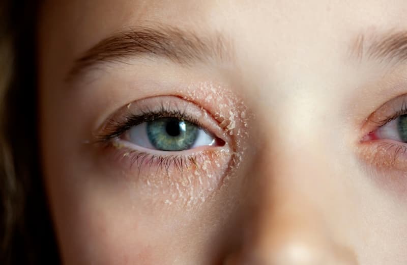 How to Treat Eczema Around Eyes: Expert Tips for Calm, Clear Skin