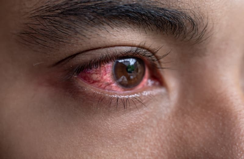 Red Eyes: Causes and Treatments
