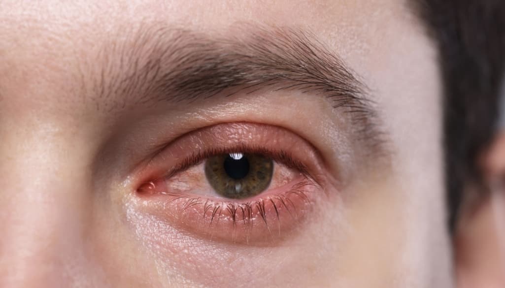 Red Spot in Your Eye? Here’s How to Heal a Broken Blood Vessel Fast