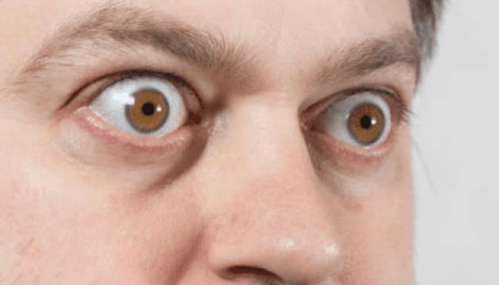 Thyroid Eye Disease: Symptoms and Treatment