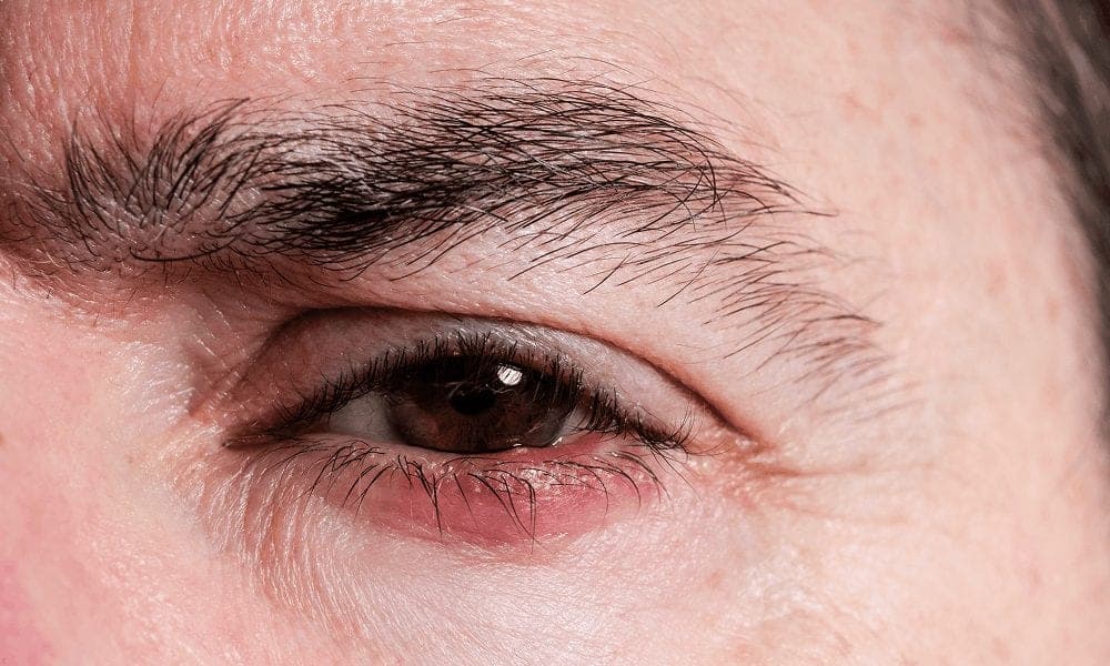 What Causes Styes in Adults?