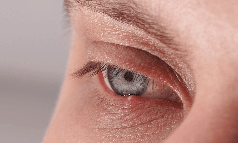 Eyelid Bumps: Symptoms, Causes & Treatments