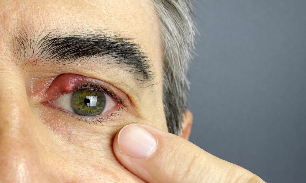 Stye Inside Eyelid: Causes, Symptoms, and Expert Treatment