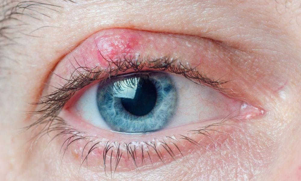 Why Do I Have a Lump on My Eyelid?