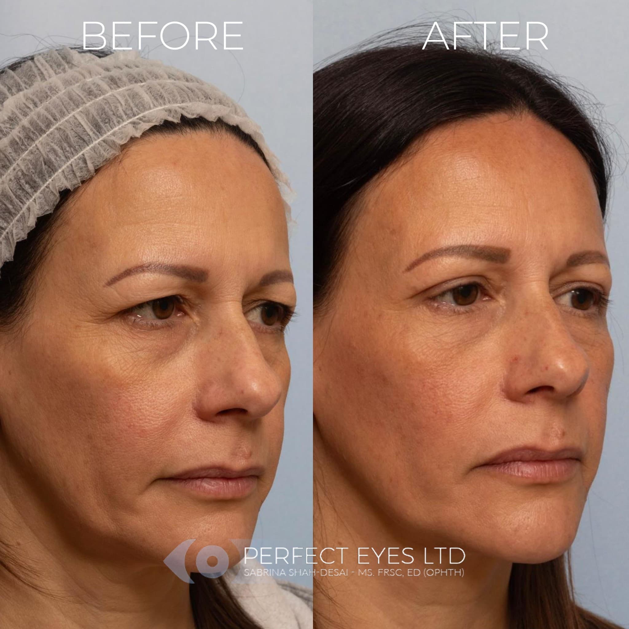 Sofwave™ before and after - case 3
