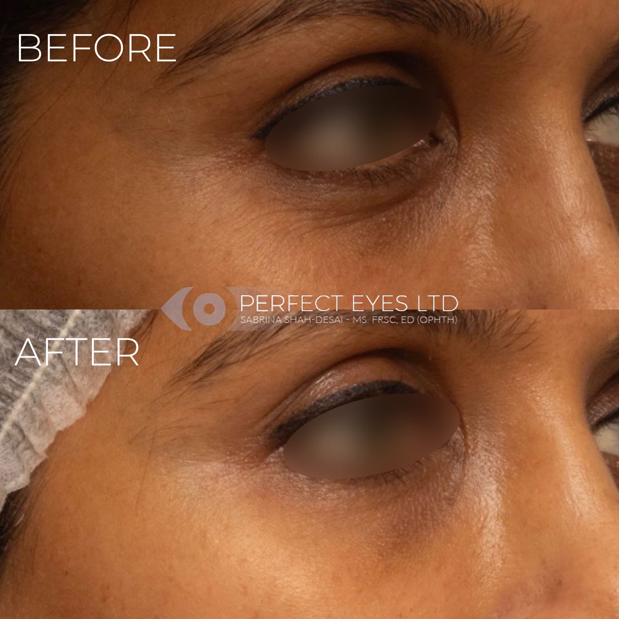 Polynucleotides before and after, a patient of Dr Sabrina Shah-Desai