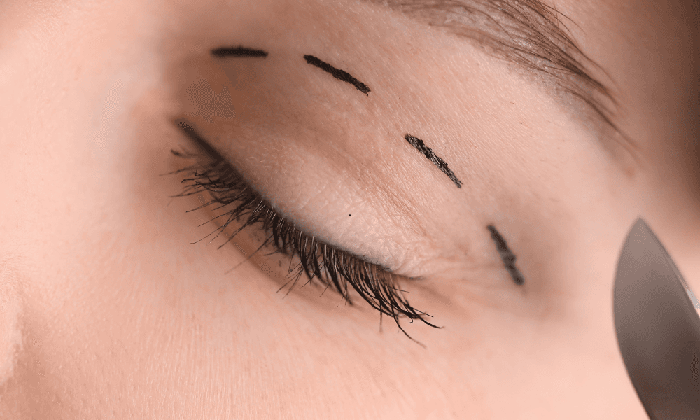Is Blepharoplasty Safe? What Every Patient Should Know