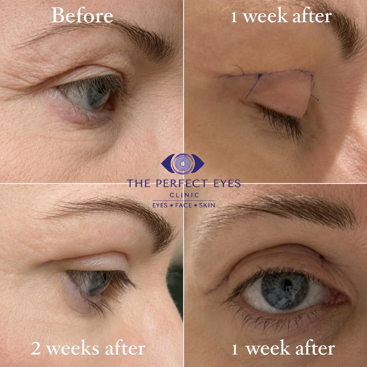 Upper blepharoplasty before and after, case 10, by Dr Sabrina Shah-Desai