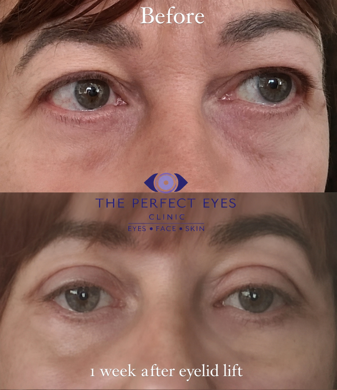 Upper blepharoplasty before and after, case 11, by Dr Sabrina Shah-Desai